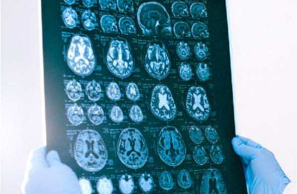 Alzheimer: la importancia de reconocer los síntomas y un diagnóstico temprano