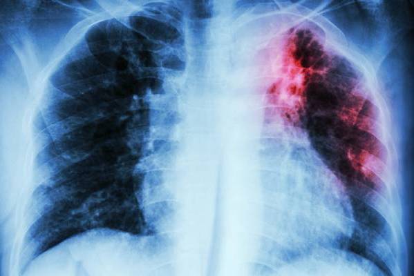 Confirman caso de tuberculosis en adulto mayor de ELEAM en Pinto